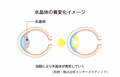 視界が黄色に見える「黄視症」