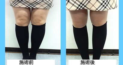 気功エステの４月限定特別料金