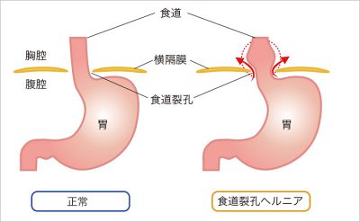 継続遠隔ヒーリング体験談：食道裂孔ヘルニアによる食欲不振の改善